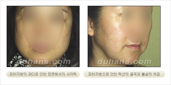 [두한성형외과 경쟁력 얼굴 미세지방흡입] - [볼살, 턱선 지방흡입 안내] 관련 이미지 1