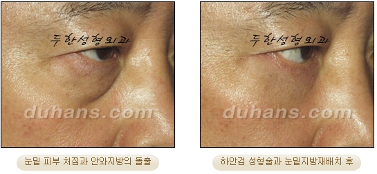 [Duhan Plastic Surgery Ophthalmic Plastic Surgery] - [Lower Blepharoplasty] image 16