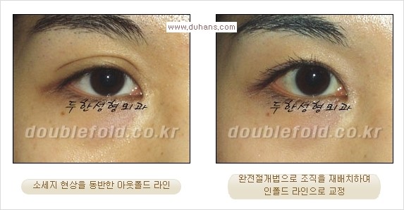 [두한성형외과 경쟁력 눈성형] - [두꺼운 아웃폴드 라인을 인폴드 라인으로 교정] 관련 이미지 4