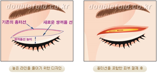 [두한성형외과 쌍커풀재수술] - [심한 소세지눈, 두줄따기, 쌍꺼풀 흉터] 관련 이미지 5
