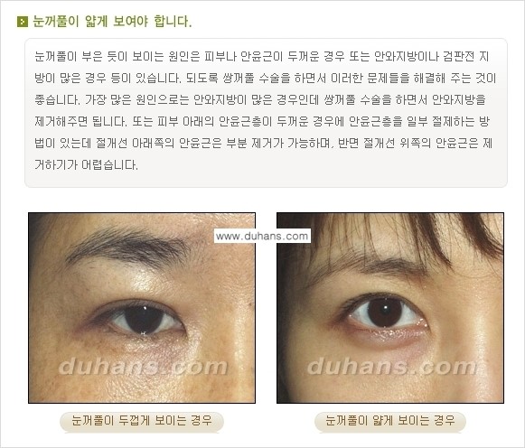 [두한성형외과 경쟁력 눈성형] - [매력적인 쌍꺼풀이란?] 관련 이미지 5