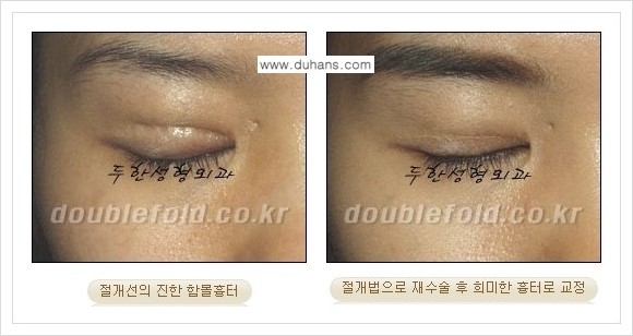 [두한성형외과 경쟁력 쌍꺼풀 재수술, 극한 재수술] - [망가진 눈 복원수술 - 흉터선이 진한 경우 교정 안내] 관련 이미지 4
