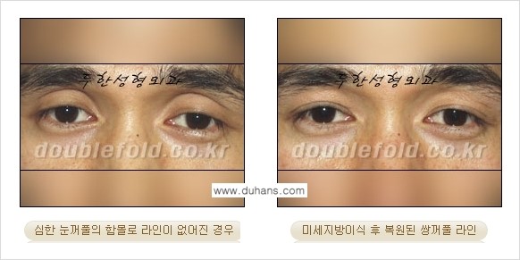 [두한성형외과 NO.1 눈성형] - [함몰된(꺼진) 눈꺼풀에서 쌍꺼풀 라인 교정 3.] 관련 이미지 8