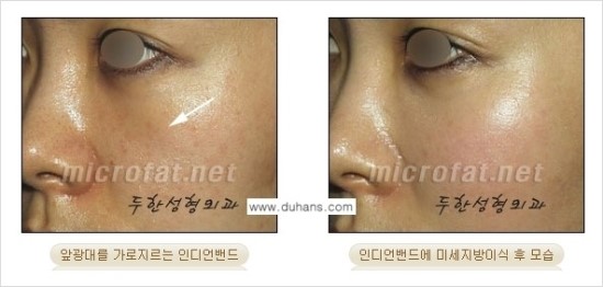 [두한성형외과 경쟁력 귀족성형] - [3차원 입체 미세지방이식 귀족수술 + 인디언밴드 교정] 관련 이미지 20
