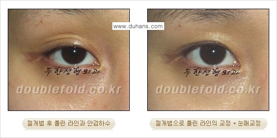 [두한성형외과 NO.1 경쟁력 눈성형] - [풀린 쌍꺼풀 절개법으로 교정하는 방법] 관련 이미지 5