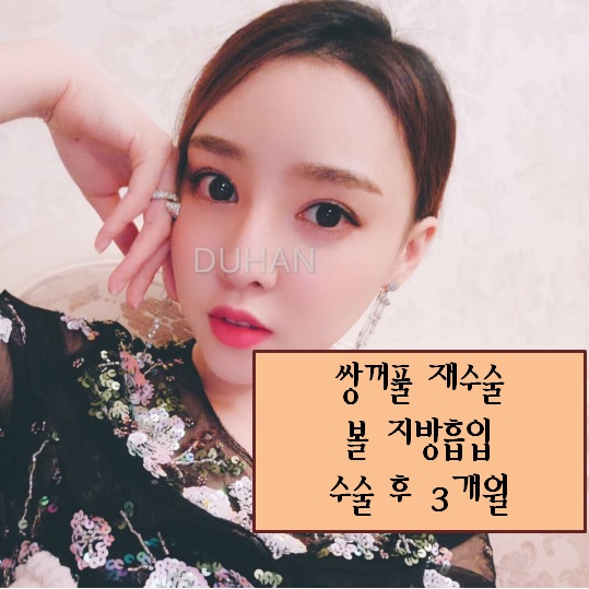 [두한성형외과] - [쌍꺼풀재수술, 눈재수술, 쌍꺼풀라인낮추기, 볼지방흡입, V라인] 관련 이미지 5