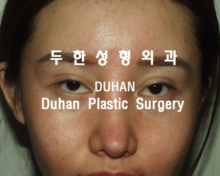 큰 아웃라인,#안검하수 #눈재수술, #애교살 #지방이식 관련 이미지 1