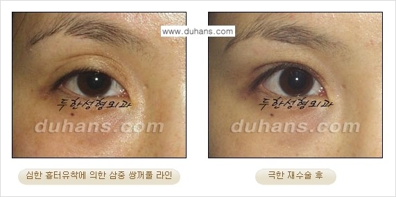 [두한성형외과 성형 FOCUS] - [정상적인 눈매로의 복원 극한재수술 경우 ②] 관련 이미지 8