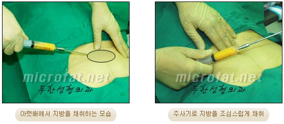 이마성형 두한성형외과 - 이마주름, 이마지방이식 관련 이미지 5