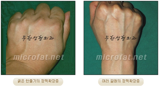 [Duhan Plastic Surgery Clinic Varicose Veins] - [Hand and Arm Venous Dilation] image 2