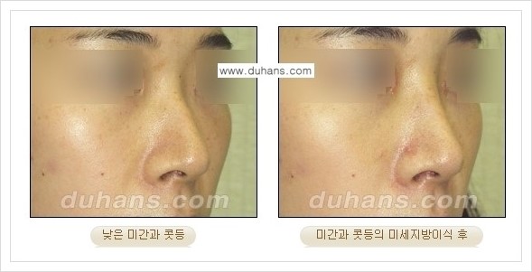 [두한성형외과 경쟁력 코성형] - [미세지방이식 코성형 안내] 관련 이미지 4