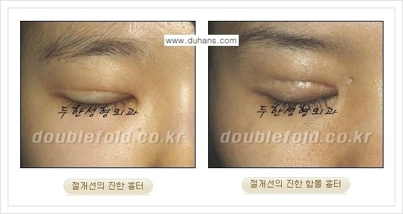 [두한성형외과 경쟁력 쌍꺼풀 재수술, 극한 재수술] - [망가진 눈 복원수술 - 흉터선이 진한 경우 교정 안내] 관련 이미지 1
