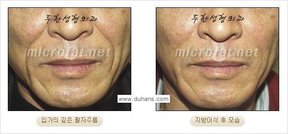 [두한성형외과의 경쟁력 있는 지방이식] - [입가주름, 팔자주름 미세지방이식 1.] 관련 이미지 13
