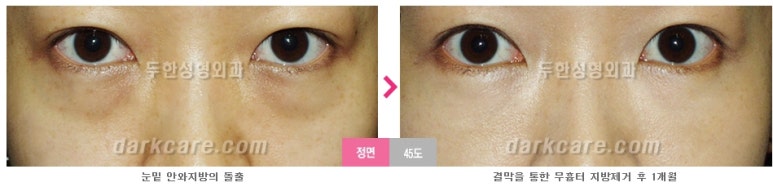 [두한성형외과 다크서클] - [다크서클 전후사진 검증] 관련 이미지 101