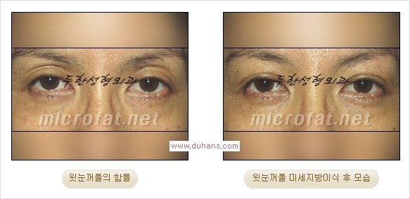[두한성형외과 Dr. 컬럼] - [눈꺼풀의 지방이식] 관련 이미지 8