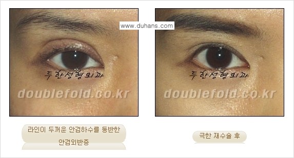 [두한성형외과 경쟁력 쌍꺼풀 재수술, 극한 눈재수술] - [망친 쌍꺼풀을 복원하는 극한 눈재수술] 관련 이미지 7