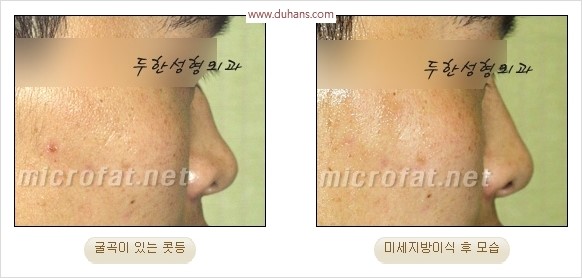 [두한성형외과 경쟁력 코성형 리더] - [자연스럽고 오똑한 콧망울! 코성형 방법]​ 관련 이미지 48