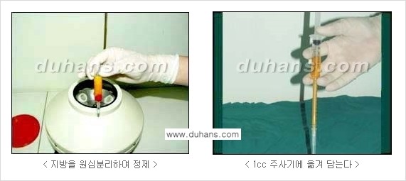 [두한성형외과 경쟁력 미세지방이식] - [다크써클 & 눈밑주름 미세지방이식 2.] 관련 이미지 4