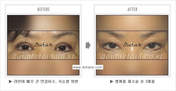 [두한성형외과 쌍꺼풀 재수술] - [눈매교정이 과한 경우의 문제] 관련 이미지 3