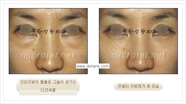[두한성형외과 경쟁력 눈밑성형] - [눈밑지방제거, 눈위지방제거 안내 1.] 관련 이미지 17