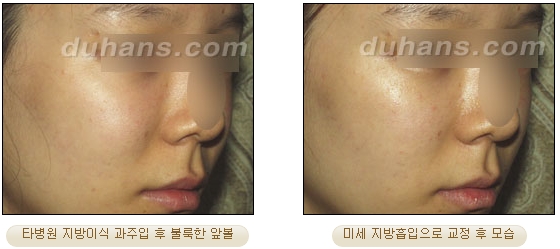 [두한성형외과 얼굴자가지방이식] - [볼살, 이마, 측두부] 관련 이미지 42
