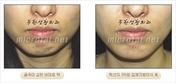 [두한성형외과 경쟁력 지방이식 리더] - [Col-fat(콜펫)지방이식, 3차원 입체지방이식, 2차원 평면지방이식] 관련 이미지 38