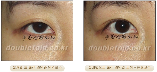 [Duhan Plastic Surgery Double Eyelid Revision Surgery] - [Ptosis Correction Surgery] image 51