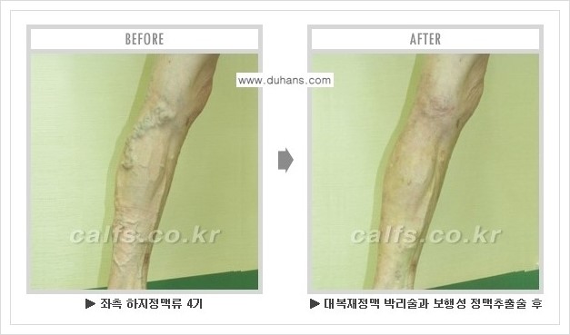 [두한성형외과 경쟁력 정맥류 치료] - [하지정맥류 사진 자료 안내 1.] 관련 이미지 11