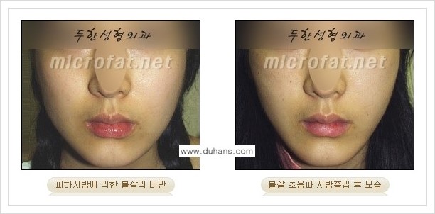 [두한성형외과 겨울엔 지방흡입을] - [볼살, 눈밑, 턱선의 초음파 미세지방흡입 2.] 관련 이미지 12