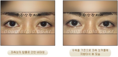 [두한성형외과 쌍커풀수술] - [쌍꺼풀지방이식] 관련 이미지 28