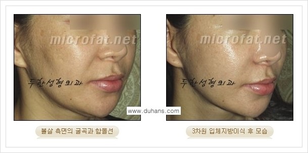 [두한성형외과 경쟁력 윤곽성형] - [볼, 볼살 지방이식] 관련 이미지 22