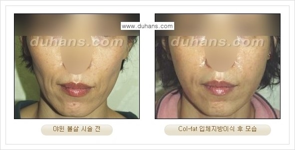 [두한성형외과 경쟁력 미세지방이식] - [지방이식 특허 Col-fat 미세지방이식 성공사례 안내] 관련 이미지 14
