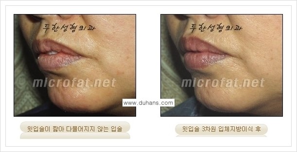 [두한성형외과 경쟁력 미세지방이식] - [입술 미세지방이식 안내] 관련 이미지 5