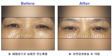 Blepharoplasty, Duhan Plastic Surgery - Upper and Lower Eyelids image 9