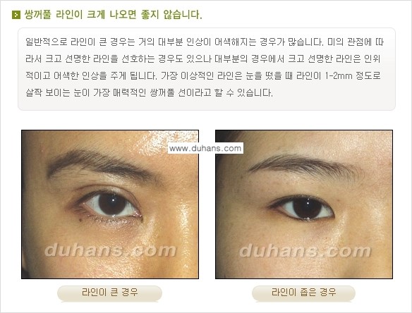 [두한성형외과 경쟁력 눈성형] - [매력적이고 아름다운 쌍꺼풀이란?] 관련 이미지 2