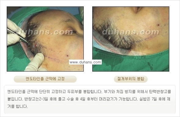[두한성형외과 젊어지는 주름교정술] - [주름제거 시술방법 ②] 관련 이미지 11
