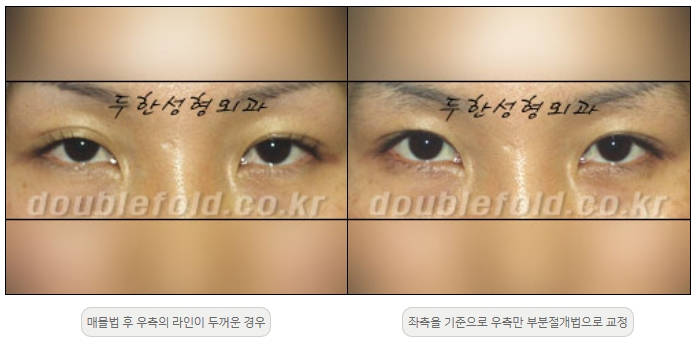 [두한성형외과 쌍커플재수술] - [비대칭 쌍커풀 라인] 관련 이미지 4