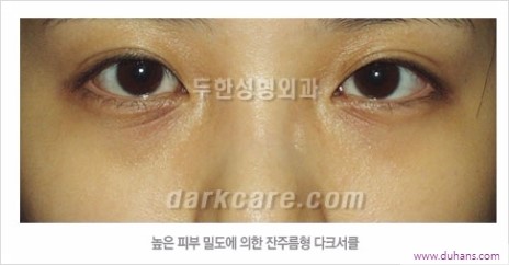 [두한성형외과 경쟁력 눈밑성형] - [하안검성형(눈밑주름제거술)과 눈밑지방재배치안내] 관련 이미지 3