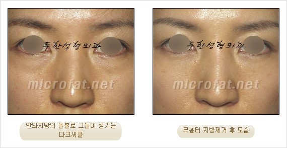 [두한성형외과 쌍커풀수술] - [눈성형 방법에 대한 자주하는 질문과 답변] 관련 이미지 179