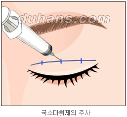 쌍커풀수술 두한성형외과 - 나에게 맞는 눈성형은? 관련 이미지 19