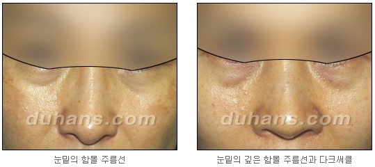 [두한성형외과 주름교정] - [주름개선 지방이식] 관련 이미지 6