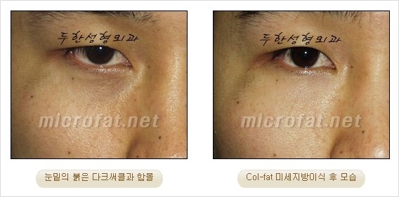 ​[두한성형외과 경쟁력 눈밑성형 리더] - [눈밑 다크써클의 증상, 원인, 종류, 치료방법 안내] 관련 이미지 19
