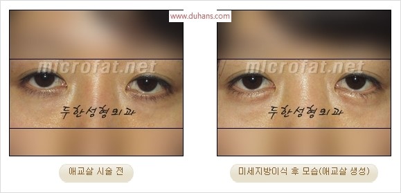 ​﻿[두한성형외과 경쟁력 지방이식] - [눈밑 애교살 시술을 위한 미세지방이식] 관련 이미지 32