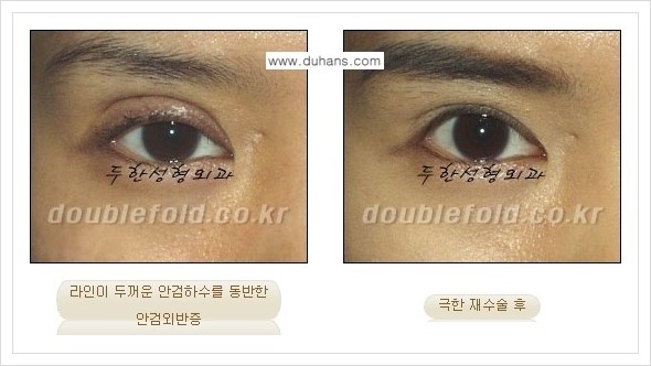 [두한성형외과 경쟁력 쌍꺼풀 재수술] - [극한의 상태에서 쌍꺼풀 재수술 안내 ②] 관련 이미지 13