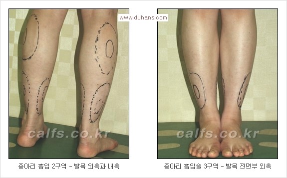 [두한성형외과 경쟁력 멀티종아리성형] - [종아리(다리) 비만 해결 방법 안내] 관련 이미지 3