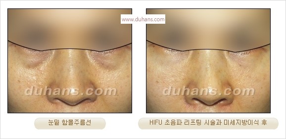 [두한성형외과 경쟁력 주름성형] - [주름제거를 위한 리프팅] 관련 이미지 55