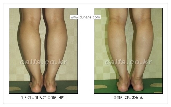 [두한성형외과 경쟁력 멀티종아리성형] - [예쁜 종아리를 만드는 종아리 지방흡입술 안내] 관련 이미지 13