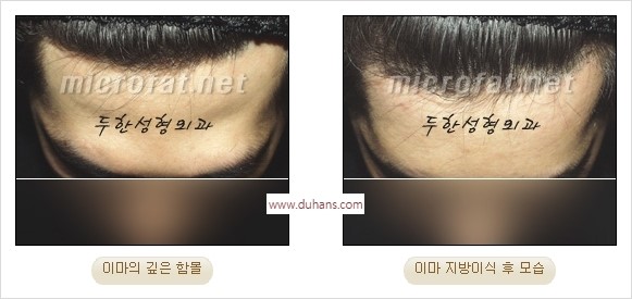 [두한성형외과 경쟁력 동안성형 리더] - ​[미간주름, 이마주름, 안검성형, 이마거상술, 눈썹거상술] 관련 이미지 31