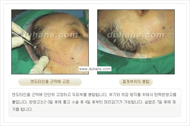[두한성형외과 경쟁력 주름성형] - [엔도타인 리프팅 안내 ①] 관련 이미지 13