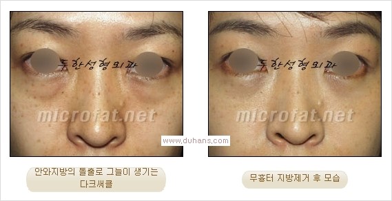 ⁠⁠[두한성형외과 경쟁력 안검성형] - [젊은 눈매를 위한 윗눈꺼풀 지방제거, 눈밑 지방제거] 관련 이미지 29